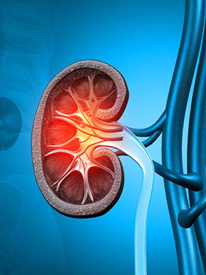 Chronic Kidney Disease treatment in Guntur