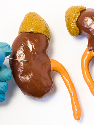 renal Biopsy in guntur